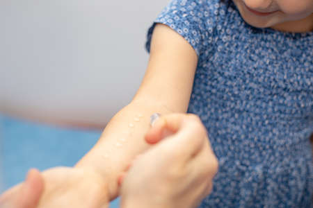 Children's allergic skin test for a child's hand. Laboratory at the Allergy clinic. Clinical study....