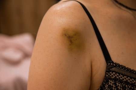 Medical documentation reveals a woman with a discreet bruise on her shoulder, prompting considerations of possible underlying conditions, trauma, or medical history captured in a single frame.の写真素材