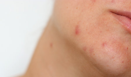 Close up of female face with red problematic acne skin and scarsの写真素材