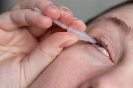 Close up of a woman applying eyedrops on red infected eye with conjunctivitis at homeの写真素材