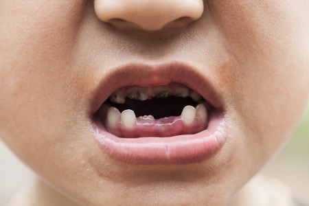 Child try to smile with decay teethの写真素材