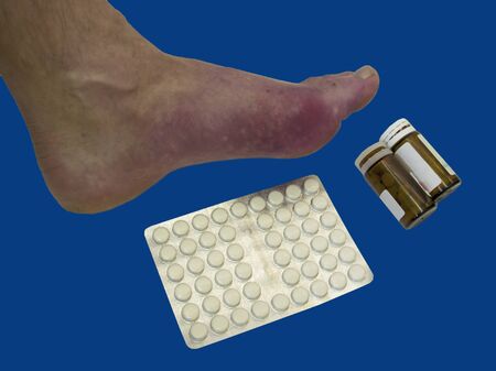 
Foot disease Rheumatism and gout. Red leg swelling. Pain in the foot.の写真素材