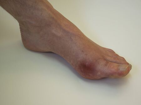 
Foot disease Rheumatism and gout. Red leg swelling. Pain in the foot.の写真素材