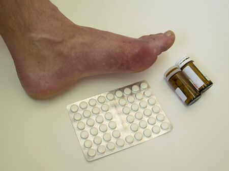 
Foot disease Rheumatism and gout. Red leg swelling. Pain in the foot.の写真素材