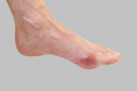 Foot disease Rheumatism and gout. Red leg swelling. Pain in the footの写真素材