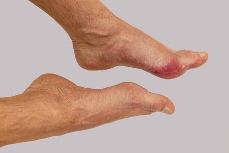 Foot disease Rheumatism and gout. Red leg swelling. Pain in the footの写真素材