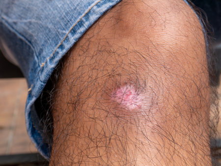 Knee Wound Bruise Injury on Human Leg Skin Medical Health Care Concept Close-Up