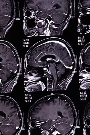 MRI scan image of brain for diagnosis