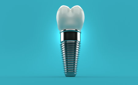 Dental implant on blue background. 3d illustrationの写真素材