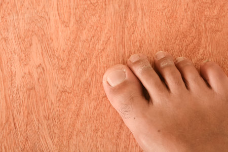 Athlete's foot, medically known as tinea pedis, fungal infection affecting the skin of the feet with...