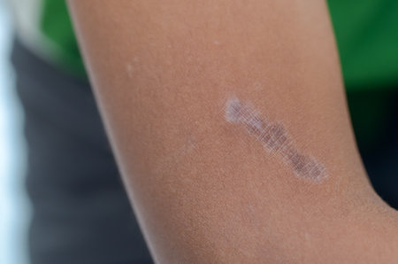 The shape and appearance of the scar suggest it may have been caused by a burn or a deep cut.の写真素材