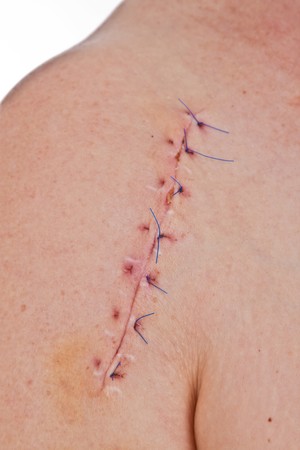 Close-up picture of a scar on a female shoulder with stitchの写真素材