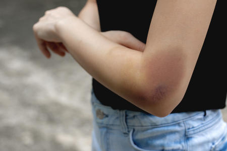 A teenager girl show a big purple bruise on her left arm that is caused by her accidentally fall off from the stairs.の写真素材