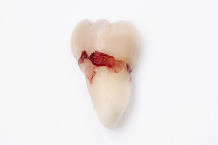 Extracted wisdom tooth stained with blood on the white background