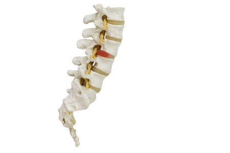 Human lambar spine model demonstating herniated disc pressure to nerve root , pressure causing back pain with clipping pathの写真素材