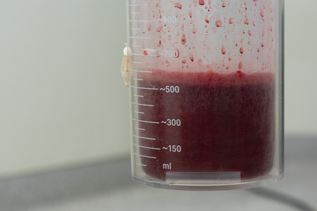 A lot of blood in a suction container during surgery in operating room