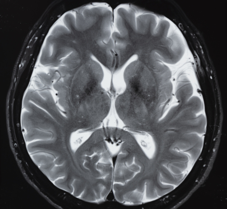 Magnetic resonance imaging in T2 study of normal human brain anatomyの写真素材