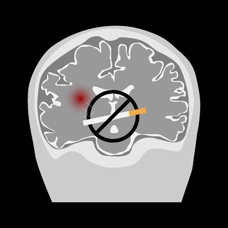 World no tobacco day. Smoking causing stroke. Illustration of no smoking sign, coronal brain image and ischemic stroke.のイラスト素材