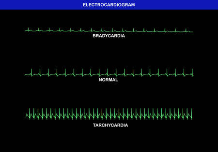 Illustration of different heart rate on electrocardiogram. Slow or bradykinesia, normal and fast or tachycardia herat rate.のイラスト素材