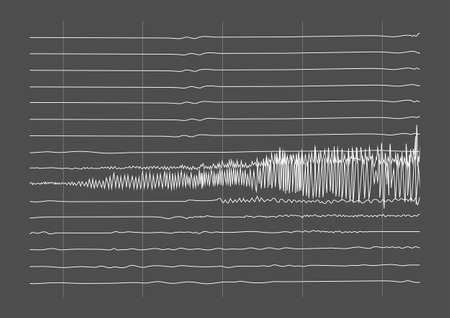 Illustration of ictal EEG recording during seizure. Seizure waves showing high amplitudes and...