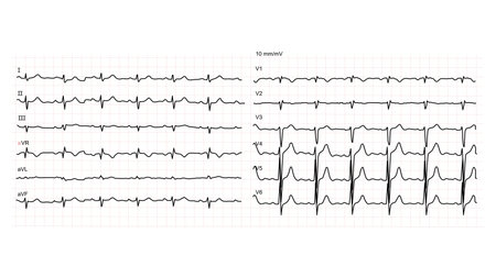 Illustration of normal human electrocardiogram or EKG on white background. Vector illustration.