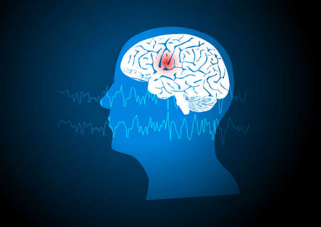 Focal seizure. Illustration of human brain and electroencephalograhy or EEG originating from one...