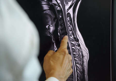 Doctor pointing at MRI of cervical spondylosis on computer screen.の写真素材