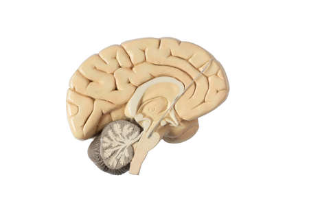 Deep brain stimulation at subthalamic nucleus for the treatment of parkinson's disease. Lead on brain model isolated on white background.の写真素材
