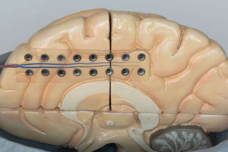 Close-up view of subdural electrode for recording brain waves or electroencephalography on medial surface of cerebral hemisphere.の写真素材