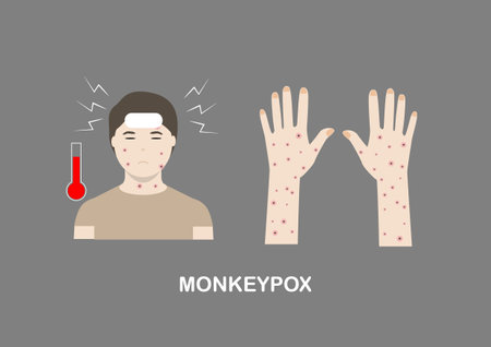 Illustration of monkeypox symptoms including fever, headache and rash on face, body and extremities.のイラスト素材