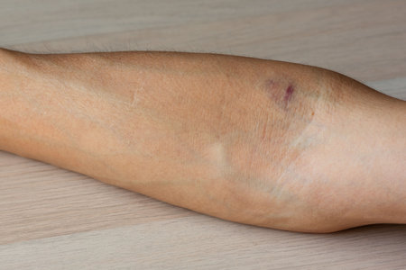 Ecchymosis on the man arm from the blood draw needle.の写真素材