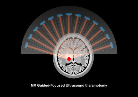 MR-guided focused ultrasound thalamotomy for the treatment of tremor in Parkinson's disease.の写真素材
