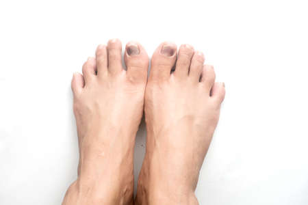 Close up view of a toe nail with purple discoloration due to an injury. The bruised toe nail is...