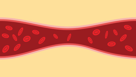 a blocked vessels with narrow stream blood cellsのイラスト素材