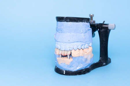 Veneers and crowns on gypsum dental artificial jaw on blue background. Upper and lower jaws plaster model with prepared teeth on diagnostic model. Concept of aesthetic dentistry. restoration of teeth. Close-up view of dental jaws prosthesisの写真素材