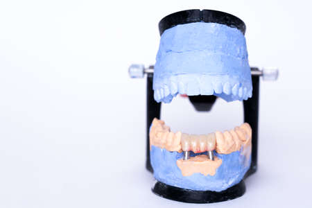 Tooth recovery with implant. Veneers and crowns on gypsum dental artificial jaw on grey background. Plaster model of teeth. White front teeth veneers on diagnostic model. Concept of aesthetic dentistry. Concept of new healthy smile. Close-up view of dental jaws prosthesisの写真素材