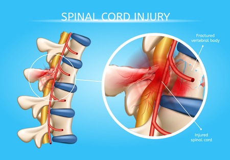 Spinal Cord Injury Vector Medical Scheme with Magnification of Fractured Vertebral Body and Damaged with Injury Spinal Cord Anatomical Realistic Illustration. Dangerous Back or Spine Trauma Conceptのイラスト素材