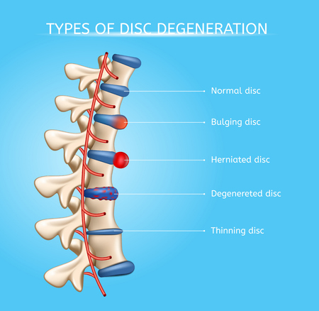 Types of Spinal Disc Degeneration Vector Medical Scheme with Normal, Bulging, Herniated, Degenerated and Thinning Discs on Human Vertebral Column Illustration. Spinal Disc Diseases Orthopedic Concept
