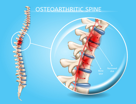 Osteoarthritic Spine Vector Medical Scheme with Magnification of Vertebral Column Area Affected by Disease, Pain Epicenter, Inflamed and Damaged with Bone Spur Narrowed Disk Realistic Illustrationのイラスト素材