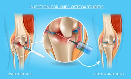 Injection for Knee Osteoarthritis Realistic Vector Medical Scheme. Medications Administration with Syringe Needle to Damaged Joint and Healthy Because of Treatment Knee Anatomical Illustrationのイラスト素材