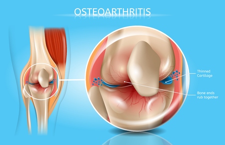 Osteoarthritis Vector Medical Poster with Magnification of Thinned Cartilage, Bone Ends Rub Together in Damaged Human Knee Joint Realistic Illustration. Musculoskeletal System Disease, Joints Injuriesのイラスト素材