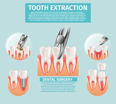 Realistic Illustration Tooth Extraction Vector 3d Banner Set