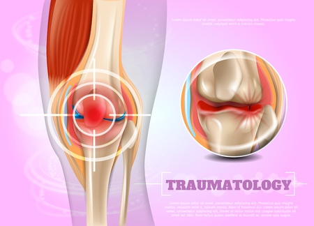 Realistic Illustration Traumatologe Medicine in 3d. Banner Vector Image Closeup Anatomy and Structure Human Knee Joint. Infographics Study Place Concentration Problems and Pain as Result Injury.のイラスト素材