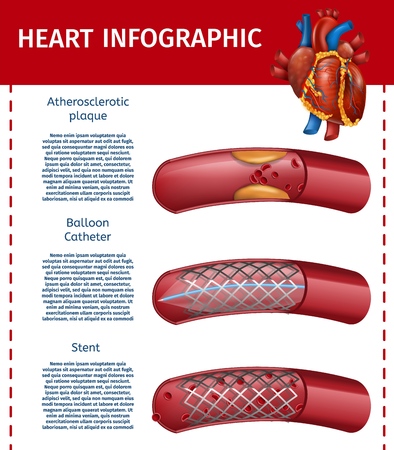 Realistic Vector Illustration Heart And Atherosclerotic Vessel