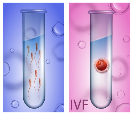 In Vitro Fertilization Vertical Banners. Male Test Tube with Active Spermatozoons on Blue Background, Female Beaker with Egg Cell on Pink Backdrop. IVF. Vector Realistic Illustration for Medical Useのイラスト素材