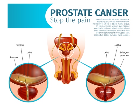 Prostate Cancer. Cancerous Tumor Cells in Prostate Gland. Male Urological Reproductive System Disease, Healthy and Inflamed Organ. Realistic Vector Anatomical Scheme Banner, Copy Space, Stop the Painのイラスト素材