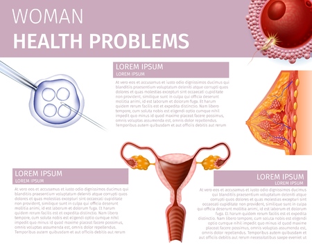 Woman Health Problems. Detailed Cross Section of Female Breast, Uterus Front View and Fertilized Egg Cell. IVF. Healthcare Vector Realistic Illustration, Educational Medical Banner with Copy Space.のイラスト素材