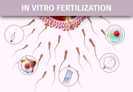 In Vitro Fertilization Process. Artificial Insemination Infographic. Scientific Medical Detailed...