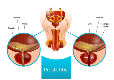 Prostatitis Scheme with Human Male Reproductive System and Demonstration Problem with Urination and Difference Between Healthy and Inflamed Prostate Gland. Vector Realistic Anatomical Illustration.のイラスト素材
