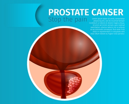 Cancerous Tumor Cells in Prostate Gland. Prostate Cancer. Stop the Pain.Male Reproductive System Anatomical Scheme. Urological Banner. Oncological Disease. Realistic Vector Illustration, Copy Space.のイラスト素材
